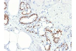 Formalin-fixed, paraffin-embedded human Breast Carcinoma stained with Estrogen Receptor, alpha Mouse Recombinant Monoclonal Antibody (rESR1/1935). (Rekombinanter Estrogen Receptor alpha Antikörper)