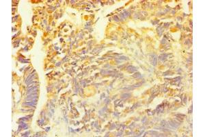 Immunohistochemistry of paraffin-embedded human ovarian cancer using ABIN7153564 at dilution of 1:100 (SNCG Antikörper  (AA 1-127))