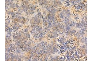 ABIN6260112 and ABIN6277506 at 1/100 staining human thymoma by IHC-P.