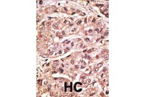 Formalin-fixed and paraffin-embedded human hepatocellular carcinoma tissue reacted with the SUMO4 polyclonal antibody  , which was peroxidase-conjugated to the secondary antibody, followed by DAB staining. (SUMO4 Antikörper  (Val55))