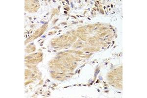 Immunohistochemistry of paraffin-embedded human gastric cancer using CASP2 Antibody. (Caspase 2 Antikörper  (AA 153-452))