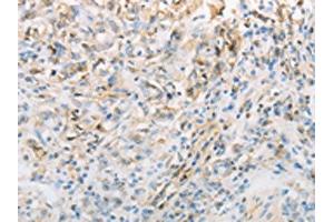 The image on the left is immunohistochemistry of paraffin-embedded Human gastic cancer tissue using ABIN7191692(NPPC Antibody) at dilution 1/70, on the right is treated with synthetic peptide. (NPPC Antikörper)