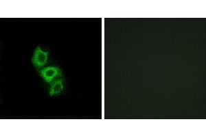 Peptide - +Immunohistochemistry analysis of paraffin-embedded human liver carcinoma tissue using APOL5 antibody. (Apolipoprotein L 5 Antikörper)