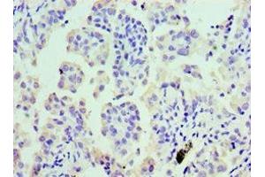 Immunohistochemistry of paraffin-embedded human lung cancer using ABIN7147984 at dilution of 1:100 (COTL1 Antikörper  (AA 1-142))