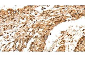 Immunohistochemistry of paraffin-embedded Human esophagus cancer using SPATA20 Polyclonal Antibody at dilution of 1:70 (SPATA20 Antikörper)