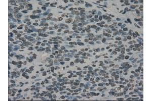 Immunohistochemical staining of paraffin-embedded Carcinoma of bladder tissue using anti-PRKYmouse monoclonal antibody. (PRKY Antikörper)