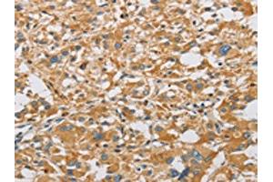 The image on the left is immunohistochemistry of paraffin-embedded Human thyroid cancer tissue using ABIN7128504(ARHGEF7 Antibody) at dilution 1/40, on the right is treated with fusion protein. (ARHGEF7 Antikörper)