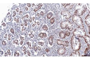 IHC-P Image Immunohistochemical analysis of paraffin-embedded human gastric cancer, using PSKH2, antibody at 1:100 dilution.