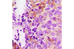 Immunohistochemistry (IHC) image for anti-PTK2 Protein tyrosine Kinase 2 (PTK2) (pTyr397) antibody (ABIN7301172)