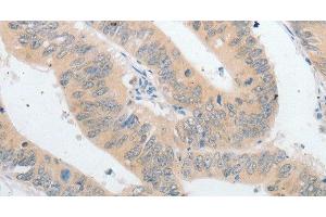 Immunohistochemistry of paraffin-embedded Human colon cancer using PLPP1 Polyclonal Antibody at dilution of 1:40 (PLPP1 Antikörper)