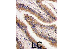 Formalin-fixed and paraffin-embedded human lung carcinoma tissue reacted with PRKX polyclonal antibody  , which was peroxidase-conjugated to the secondary antibody, followed by DAB staining. (PRKX Antikörper  (C-Term))