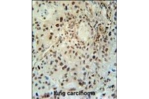 ABHEB Antibody (C-term) (ABIN653654 and ABIN2842995) immunohistochemistry analysis in formalin fixed and paraffin embedded human lung carcinoma followed by peroxidase conjugation of the secondary antibody and DAB staining. (ABHD14B Antikörper  (C-Term))