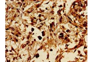 Immunohistochemistry of paraffin-embedded human melanoma using ABIN7154494 at dilution of 1:100 (PIK3R1 Antikörper  (AA 15-180))