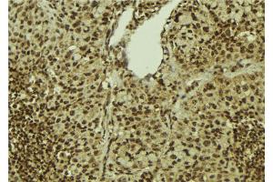 ABIN6272401 at 1/100 staining Human breast cancer tissue by IHC-P.