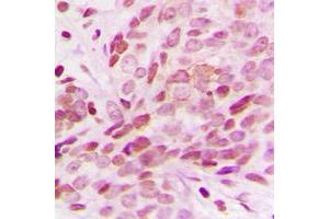 Immunohistochemical analysis of G15 staining in human breast cancer formalin fixed paraffin embedded tissue section. (AGPAT1 Antikörper  (Center))