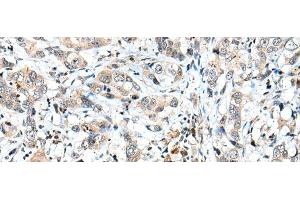 Immunohistochemistry of paraffin-embedded Human breast cancer tissue using SPCS2 Polyclonal Antibody at dilution of 1:40(x200) (SPCS2 Antikörper)