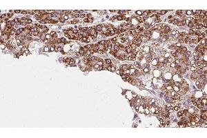 ABIN6272977 at 1/100 staining Human liver cancer tissue by IHC-P. (PTPRU Antikörper  (Internal Region))