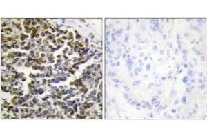 Immunohistochemistry analysis of paraffin-embedded human lung carcinoma tissue, using TCOF1 Antibody. (TCOF1 Antikörper  (AA 41-90))