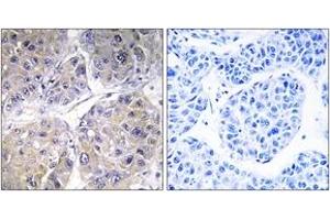 Immunohistochemistry analysis of paraffin-embedded human liver carcinoma tissue, using SLC27A5 Antibody.