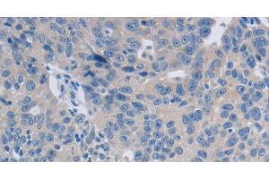 Immunohistochemistry of paraffin-embedded Human ovarian cancer tissue using GRIN1 Polyclonal Antibody at dilution 1:50 (GRIN1/NMDAR1 Antikörper)