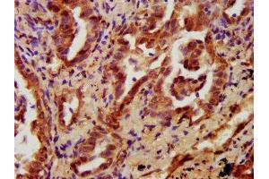 IHC image of ABIN7165707 diluted at 1:700 and staining in paraffin-embedded human lung cancer performed on a Leica BondTM system. (PKC eta Antikörper  (AA 1-678))