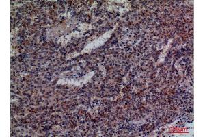 Immunohistochemistry (IHC) analysis of paraffin-embedded Human Lung Cancer, antibody was diluted at 1:100.