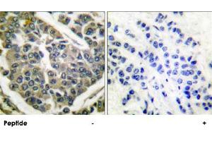 Immunohistochemical analysis of paraffin-embedded human breast carcinoma tissue using COL4A1 polyclonal antibody . (COL4A1 Antikörper  (AA 31-70))