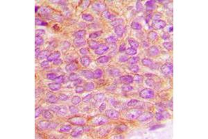 Immunohistochemical analysis of JAK2 (pY1007) staining in human breast cancer formalin fixed paraffin embedded tissue section. (JAK2 Antikörper  (C-Term, pTyr1007))