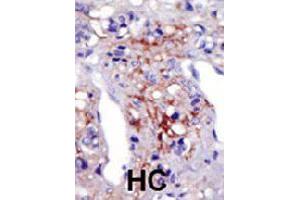 Formalin-fixed and paraffin-embedded human hepatocellular carcinoma tissue reacted with PIP5K1C polyclonal antibody  , which was peroxidase-conjugated to the secondary antibody, followed by AEC staining. (PIP5K1C Antikörper  (N-Term))