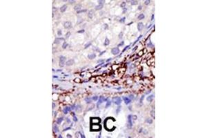 Formalin-fixed and paraffin-embedded human cancer tissue reacted with the primary antibody, which was peroxidase-conjugated to the secondary antibody, followed by DAB staining. (RNF216 Antikörper  (C-Term))