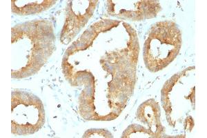 Formalin-fixed, paraffin-embedded human Breast Carcinoma stained with GRP94 Rat Monoclonal Antibody (9G10.