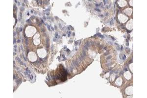 ABIN6267374 at 1/200 staining human colon cancer tissue sections by IHC-P. (Src Antikörper  (pTyr419))