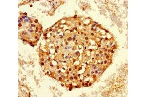 Immunohistochemistry of paraffin-embedded human breast cancer using ABIN7155138 at dilution of 1:100 (HNRNPA2B1 Antikörper  (AA 1-249))