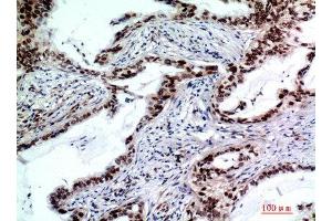 Immunohistochemistry (IHC) analysis of paraffin-embedded Human Lungcancer, antibody was diluted at 1:200.
