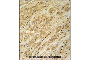 DKC1 Antibody immunohistochemistry analysis in formalin fixed and paraffin embedded human prostate carcinoma followed by peroxidase conjugation of the secondary antibody and DAB staining. (DKC1 Antikörper  (AA 185-213))