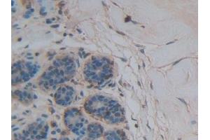 Detection of THBS1 in Human Breast cancer Tissue using Polyclonal Antibody to Thrombospondin 1 (THBS1) (Thrombospondin 1 Antikörper  (AA 24-221))