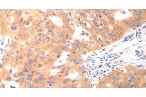 Immunohistochemistry of paraffin-embedded Human ovarian cancer using CAPNS1 Polyclonal Antibody at dilution of 1:60 (Calpain S1 Antikörper)