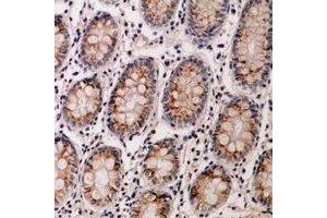 Immunohistochemical analysis of IL-12B staining in human colon cancer formalin fixed paraffin embedded tissue section. (IL12B Antikörper  (C-Term))