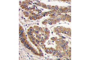 Formalin-fixed and paraffin-embedded human lung carcinoma tissue reacted with PKC zeta antibody (N-term), which was peroxidase-conjugated to the secondary antibody, followed by DAB staining. (PKC zeta Antikörper  (N-Term))