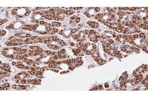 ABIN6272414 at 1/100 staining Human liver cancer tissue by IHC-P. (RHOG Antikörper  (Internal Region))