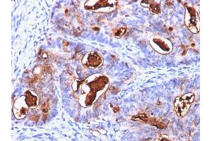 Formalin-fixed, paraffin-embedded human Colon Carcinoma stained with CEA Mouse Monoclonal Antibody (C66/1260). (CEACAM5 Antikörper)