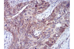 Immunohistochemical analysis of paraffin-embedded human cervical cancer tissues using SELL mouse mAb with DAB staining. (L-Selectin Antikörper  (AA 83-186))