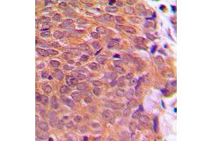 Immunohistochemical analysis of Cofilin (pS3) staining in human breast cancer formalin fixed paraffin embedded tissue section. (Cofilin Antikörper  (N-Term, pSer3))