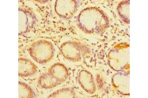 Immunohistochemistry of paraffin-embedded human gastric cancer using ABIN7173760 at dilution of 1:100