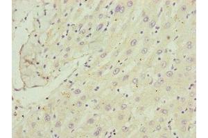 Immunohistochemistry of paraffin-embedded human liver cancer using ABIN7148370 at dilution of 1:100 (C8B Antikörper  (AA 55-350))