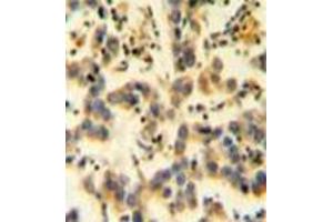 Immunohistochemistry analysis in formalin fixed and paraffin embedded human testis carcinoma reacted with KIAA0090 Antibody (C-term) followed which was peroxidase conjugated to the secondary antibody and followed by DAB staining. (KIAA0090 Antikörper  (C-Term))