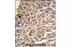 Formalin-fixed and paraffin-embedded human lung carcinoma tissue reacted with RIP3 (RIPK3) antibody (N-term) (ABIN391272 and ABIN2841322) , which was peroxidase-conjugated to the secondary antibody, followed by DAB staining. (RIPK3 Antikörper  (N-Term))