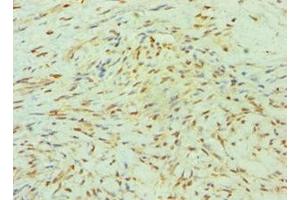Immunohistochemistry of paraffin-embedded human breast cancer using ABIN7155524 at dilution of 1:100 (SMYD3 Antikörper  (AA 199-428))