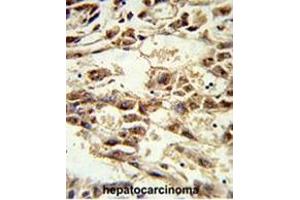 Formalin-fixed and paraffin-embedded human hepatocarcinoma reacted with AIFM2 Antibody (C-term), which was peroxidase-conjugated to the secondary antibody, followed by DAB staining. (AIFM2 Antikörper  (C-Term))