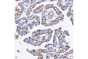 Immunohistochemistry of paraffin-embedded Human thyroid cancer using IL23R Rabbit pAb (ABIN3022245, ABIN3022246, ABIN3022247, ABIN1513088 and ABIN6218691) at dilution of 1:100 (40x lens).